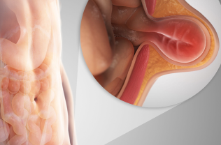 Is it possible to prevent obesity?: